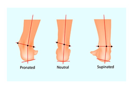 Treatment Options for Overpronation