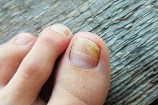 Toenail Fungus Is Treatable