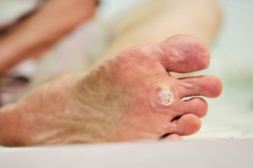 All About Plantar Warts